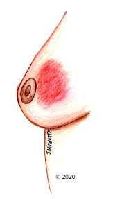 La mastite 21 mastite